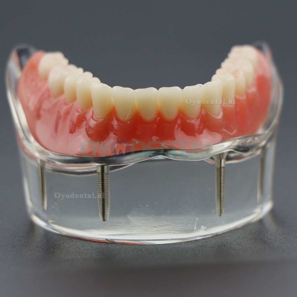 Demo-onderzoek tandheelkundige onderste tanden Model 6002 02 Overdenture Inferior 4 implantaten